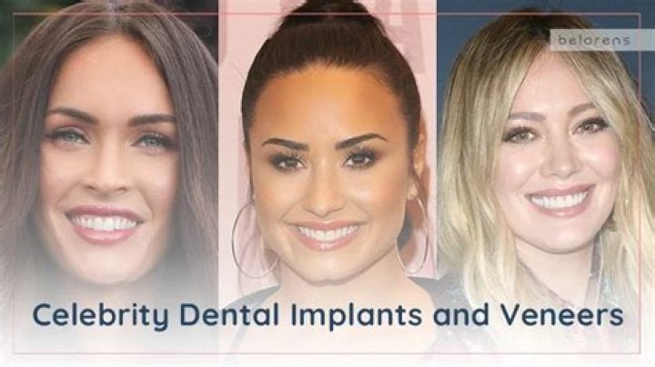 Celebrity Dental Implants: See the Stunning Transformations!