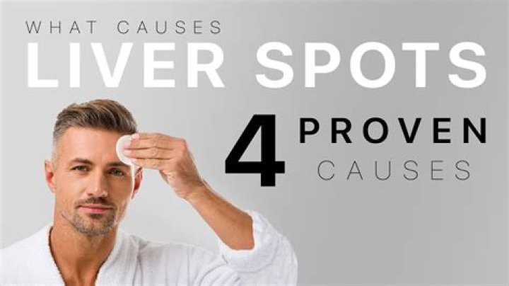 Dealing with Liver Spots: Causes & Treatment Options