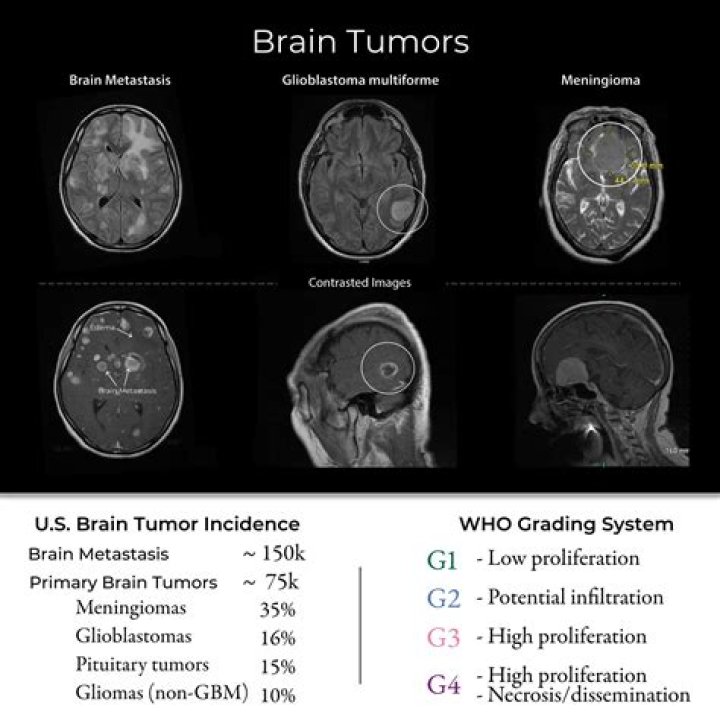 Eye Exams & Brain Tumors: Can Your Eyes Reveal a Problem?
