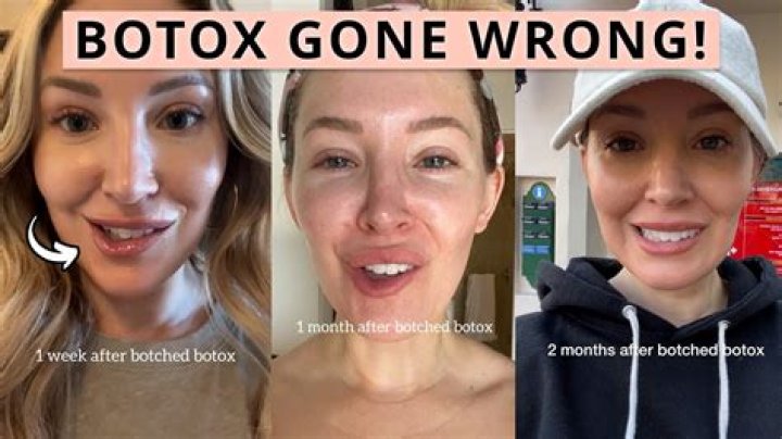 Lyn May: Age, Career & Botched Botox - The Untold Story